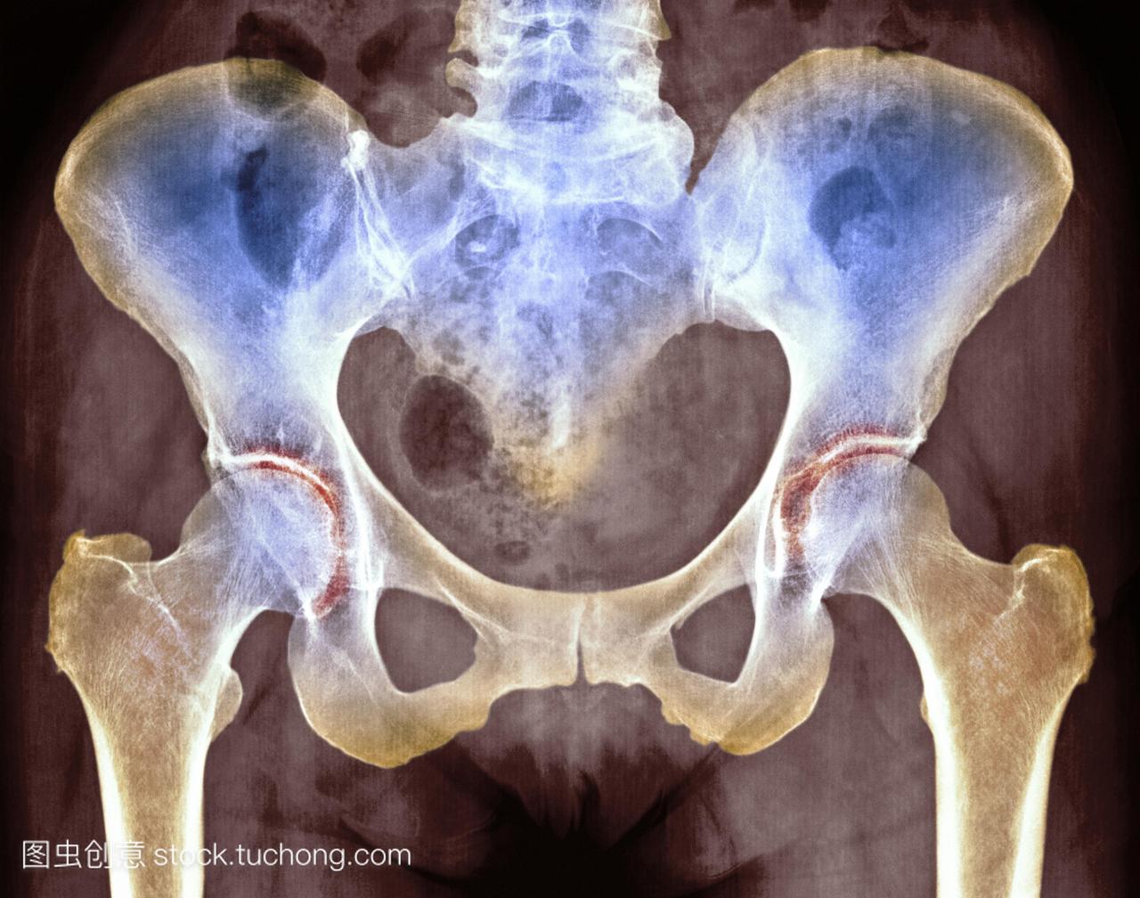 一名72岁妇女骨盆的彩色x光