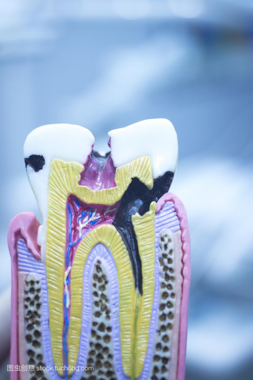 牙科牙齿铸造模型显示朽烂牙釉质根