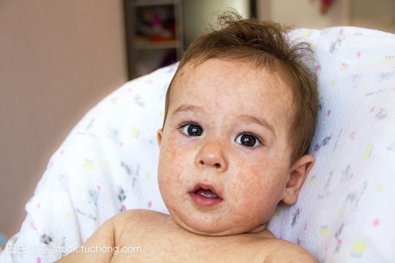 皮疹皮炎问题的婴儿。患有食物过敏的过敏。特