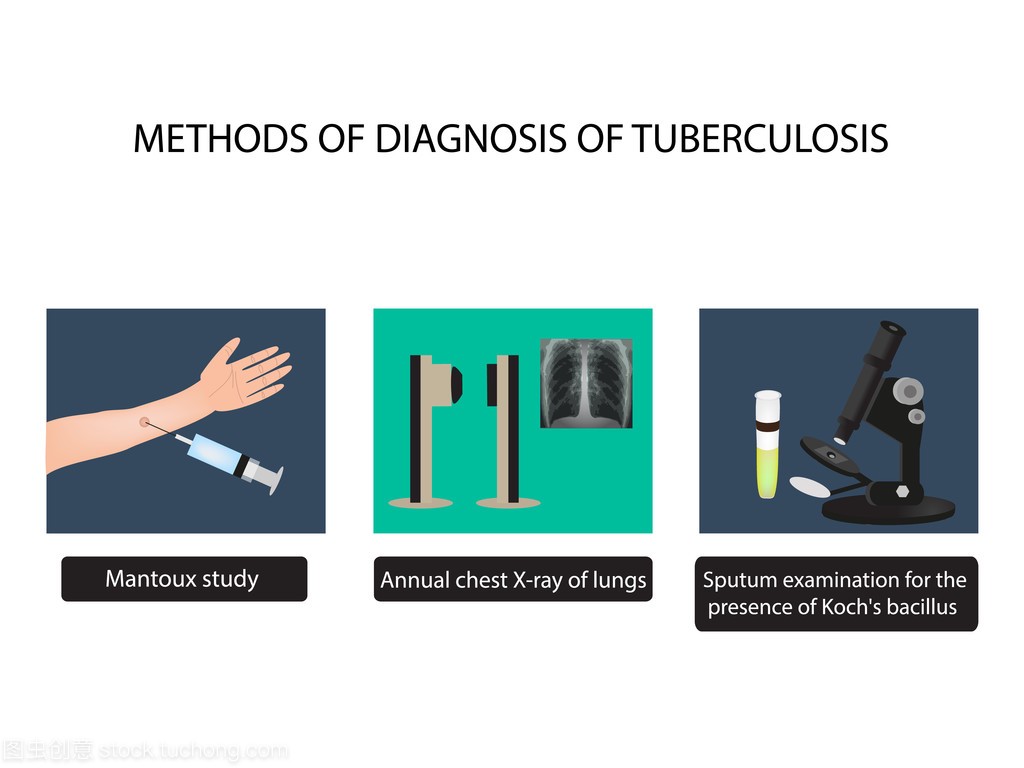 结核病的诊断方法。X-射线的光。种结核菌素试
