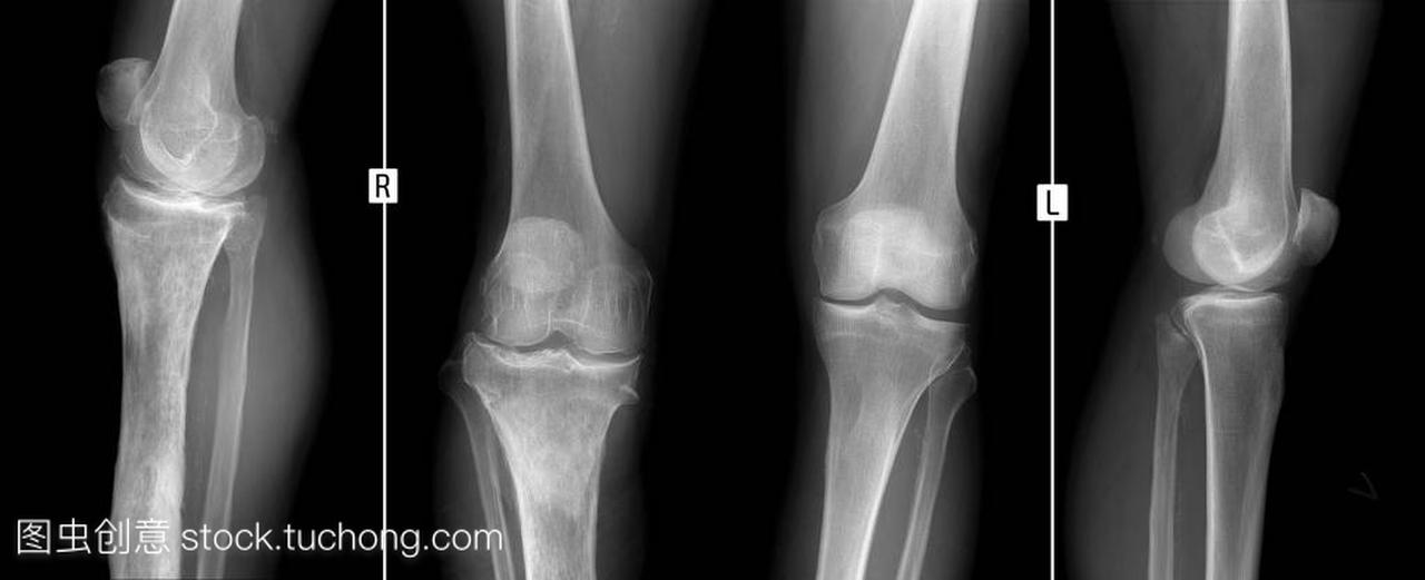 X 射线的膝关节。右胫骨骨髓炎
