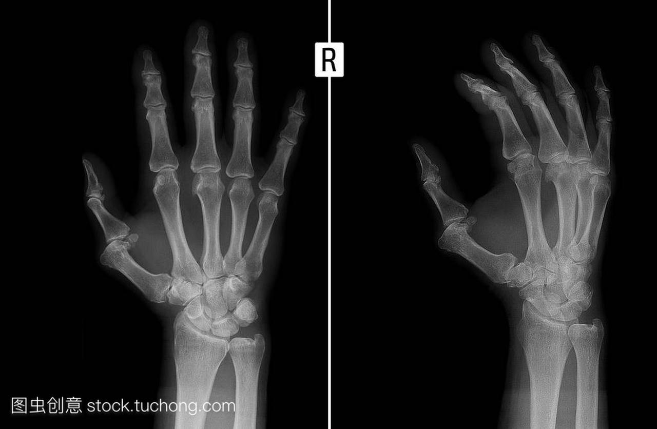 X 射线的手。显示右手食指指骨关节的半脱位