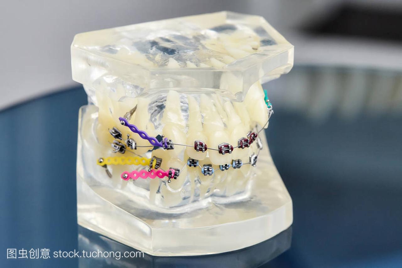 植入物,牙齿矫正牙齿正畸牙颌模型