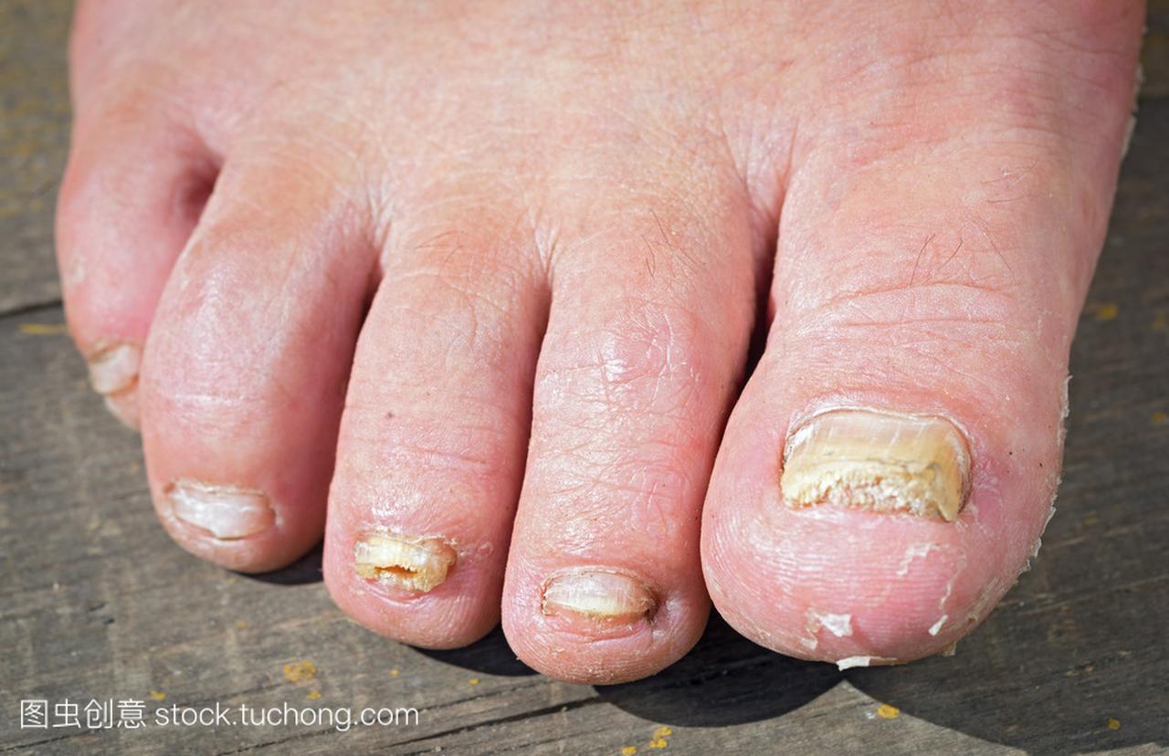 人的脚指甲上的真菌感染