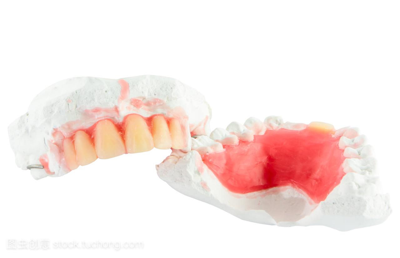 全口义齿牙蜡模型与隔离