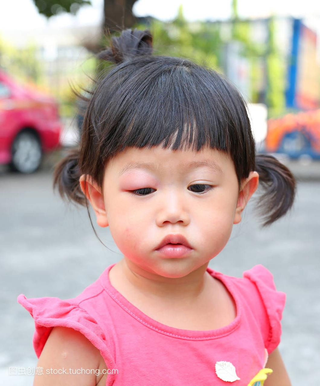 亚洲宝贝女孩眼睛肿胀,过敏后蚊子咬在眼睛的