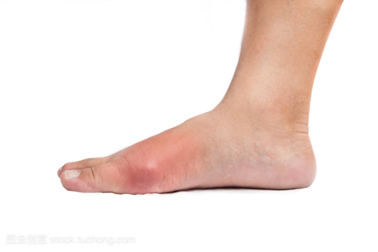 由痛苦痛风炎症引起的变形的大脚趾。