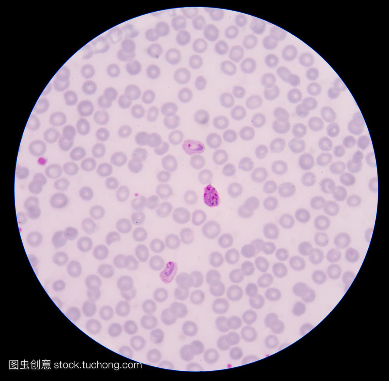 血液涂片薄膜疟疾寄生虫阳性