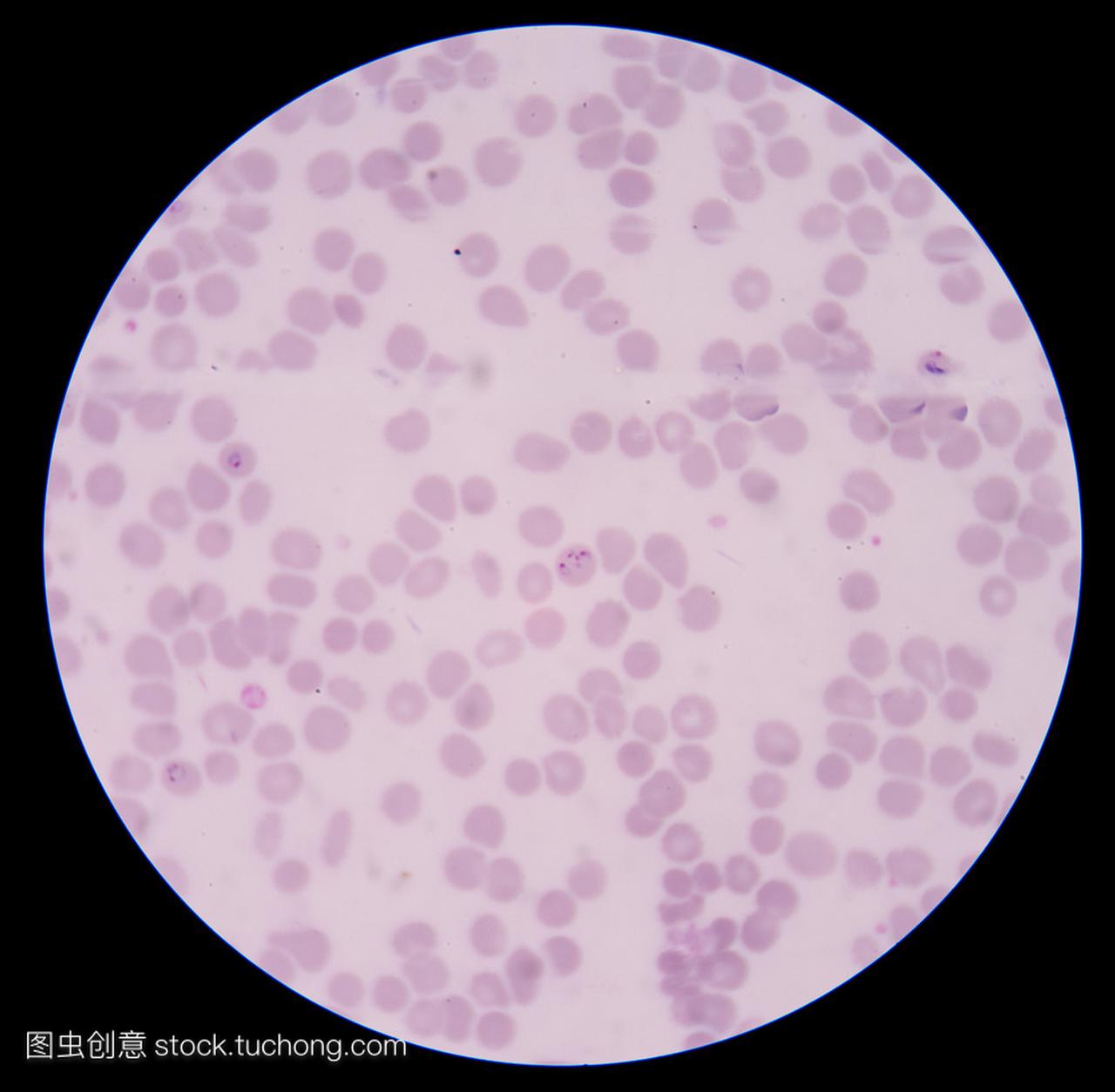 血液涂片: 疟疾寄生虫: 疟原虫 facifarum (工频)