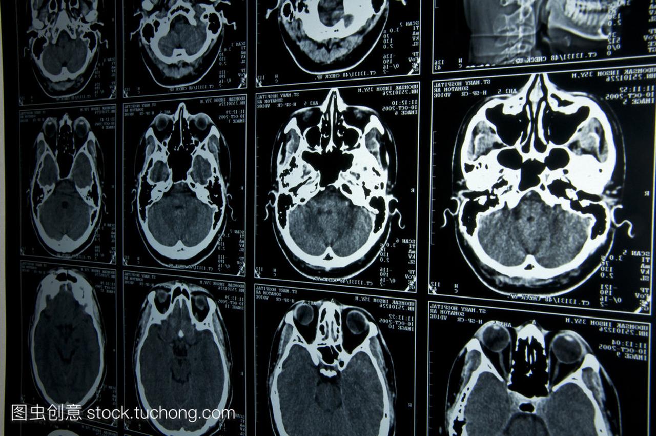 脑部扫描与磁共振成像