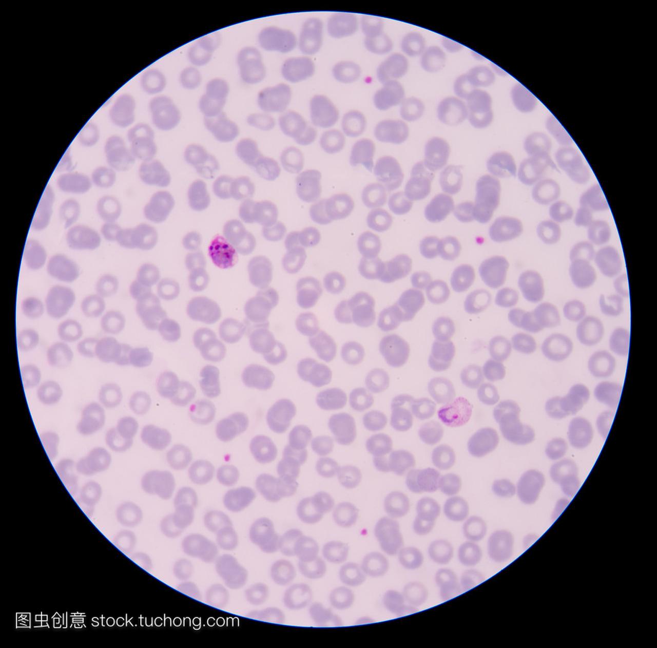 血液涂片薄膜疟疾寄生虫阳性