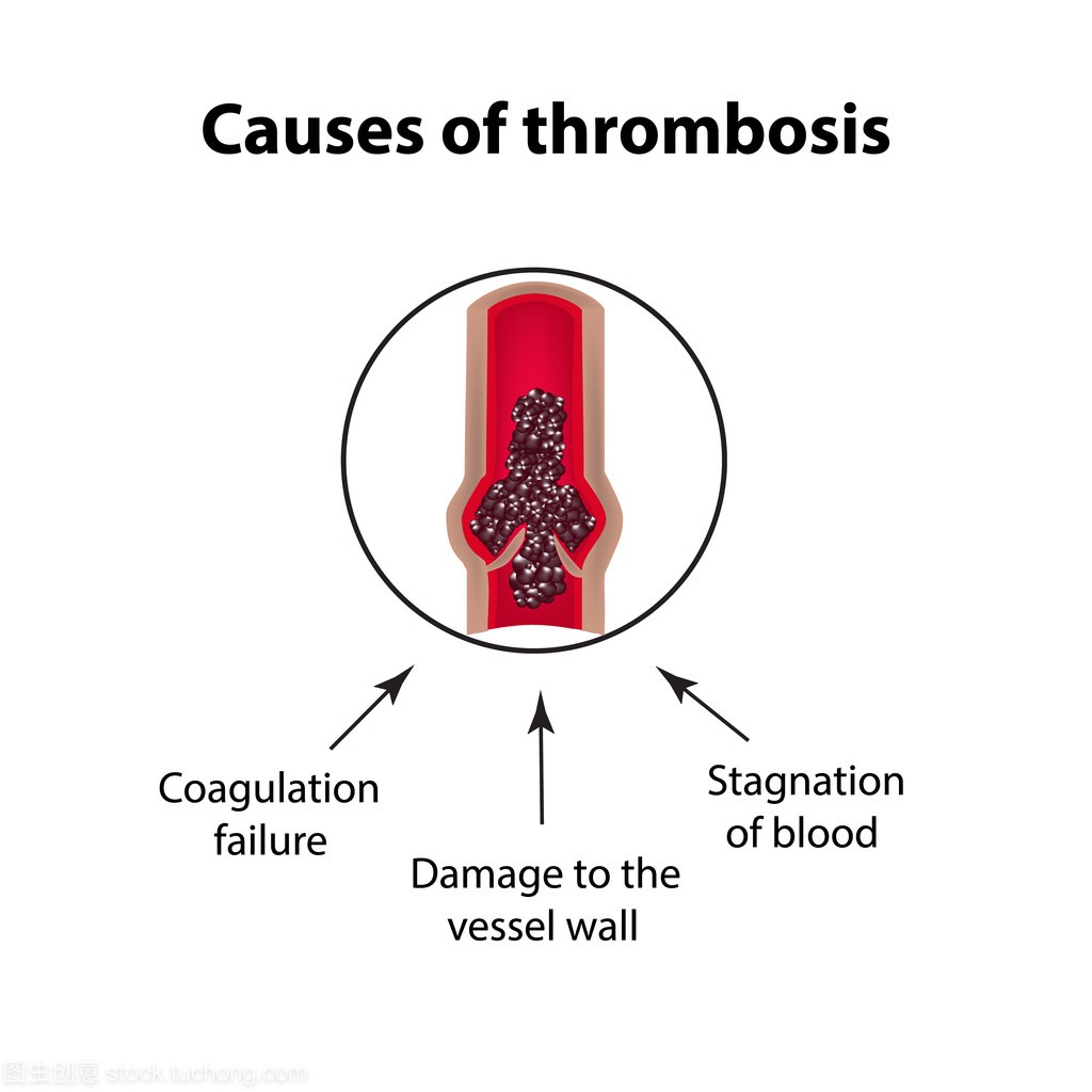 血小板增多症的原因。栓塞。信息图表。对孤立