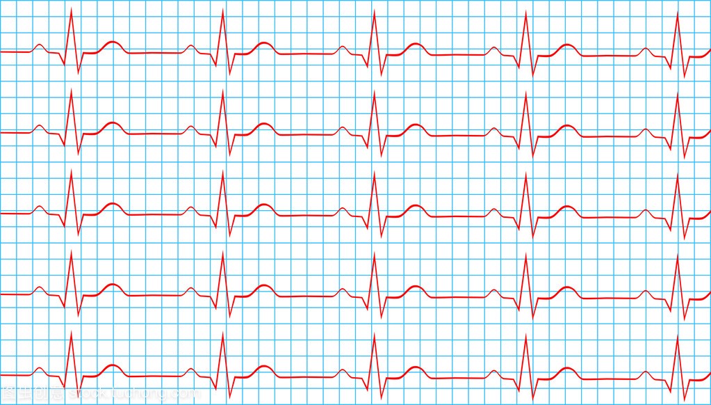 心脏正常的窦性心律的心电图记录