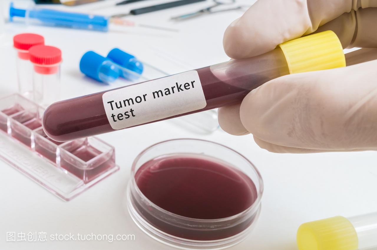 科学家认为试管与癌症患者的肿瘤标记物检测