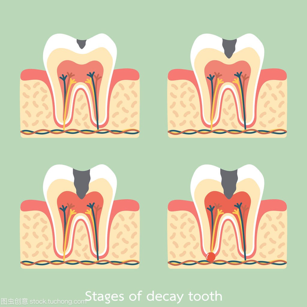 朽烂牙解剖结构包括骨和口香糖的阶段
