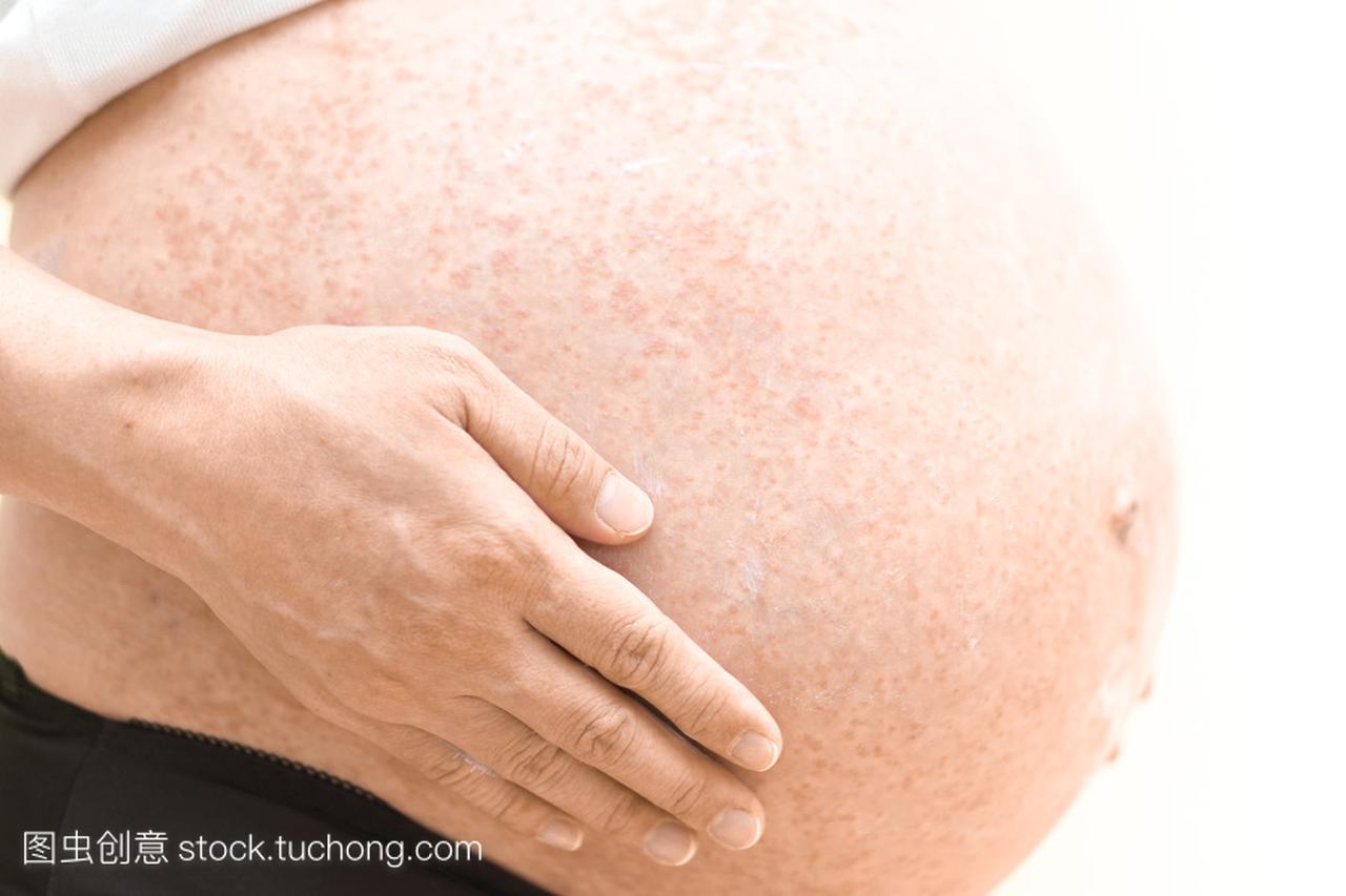 孕晚期孕妇身上长湿疹怎么办？ - 知乎