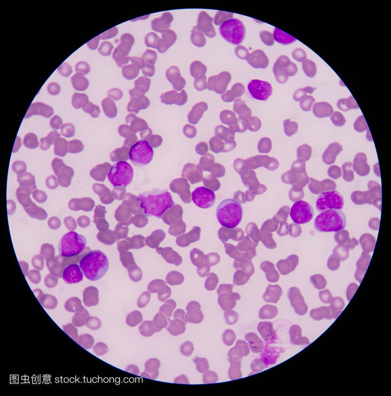 血液癌症。涂片显示大量的癌症白血病 cel