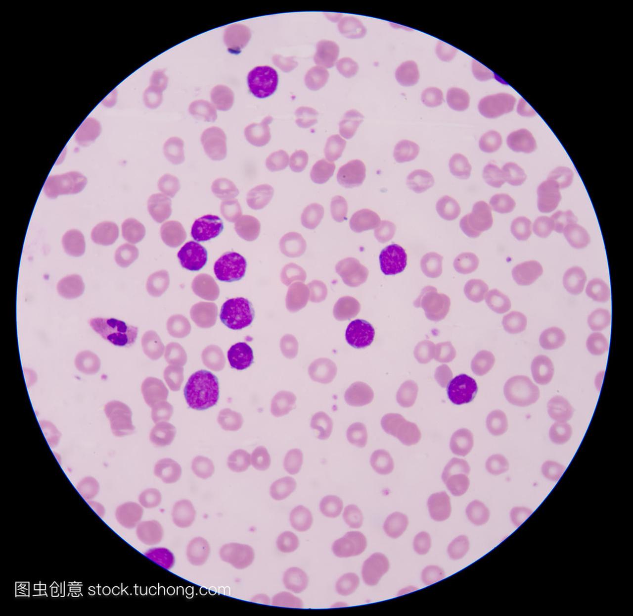 血液癌症。涂片显示大量的癌症白血病 cel