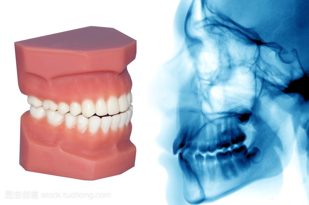 牙齿模型和 x 射线与一个孤立