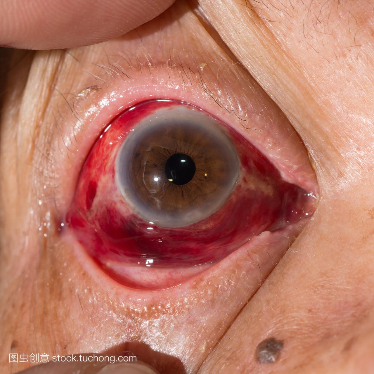 球结膜下出血在眼试验