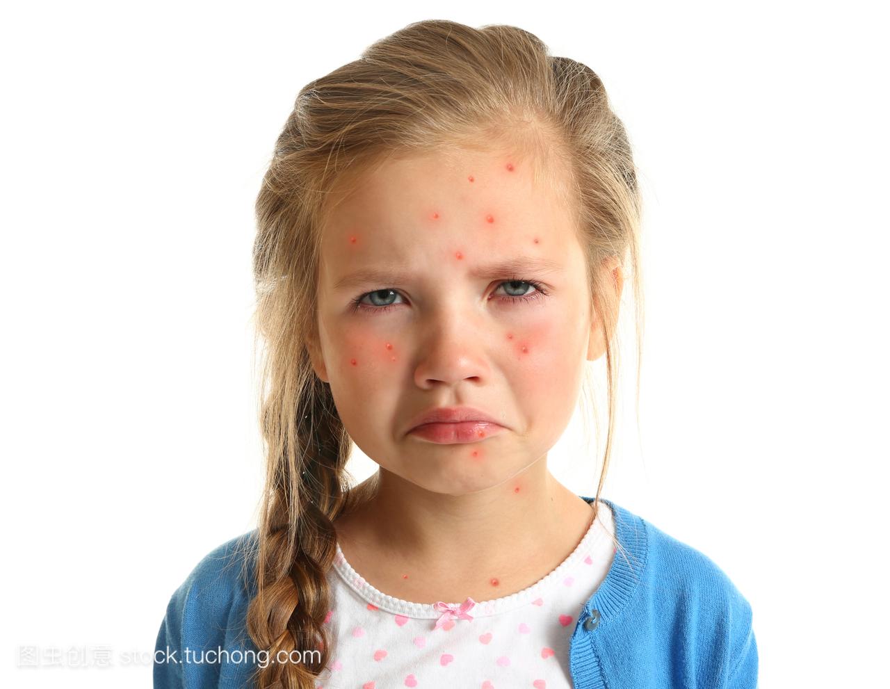 白色背景的小女孩与红色丘疹。水痘概念