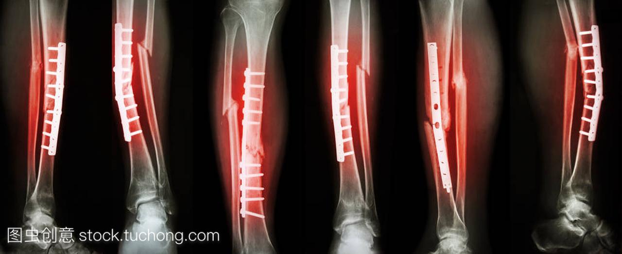 小腿骨折和以钢板螺钉内固定手术治疗的集合形
