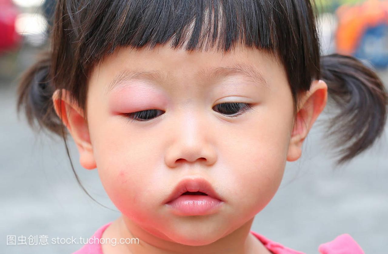 亚洲宝贝女孩眼睛肿胀,过敏后蚊子咬在眼睛的