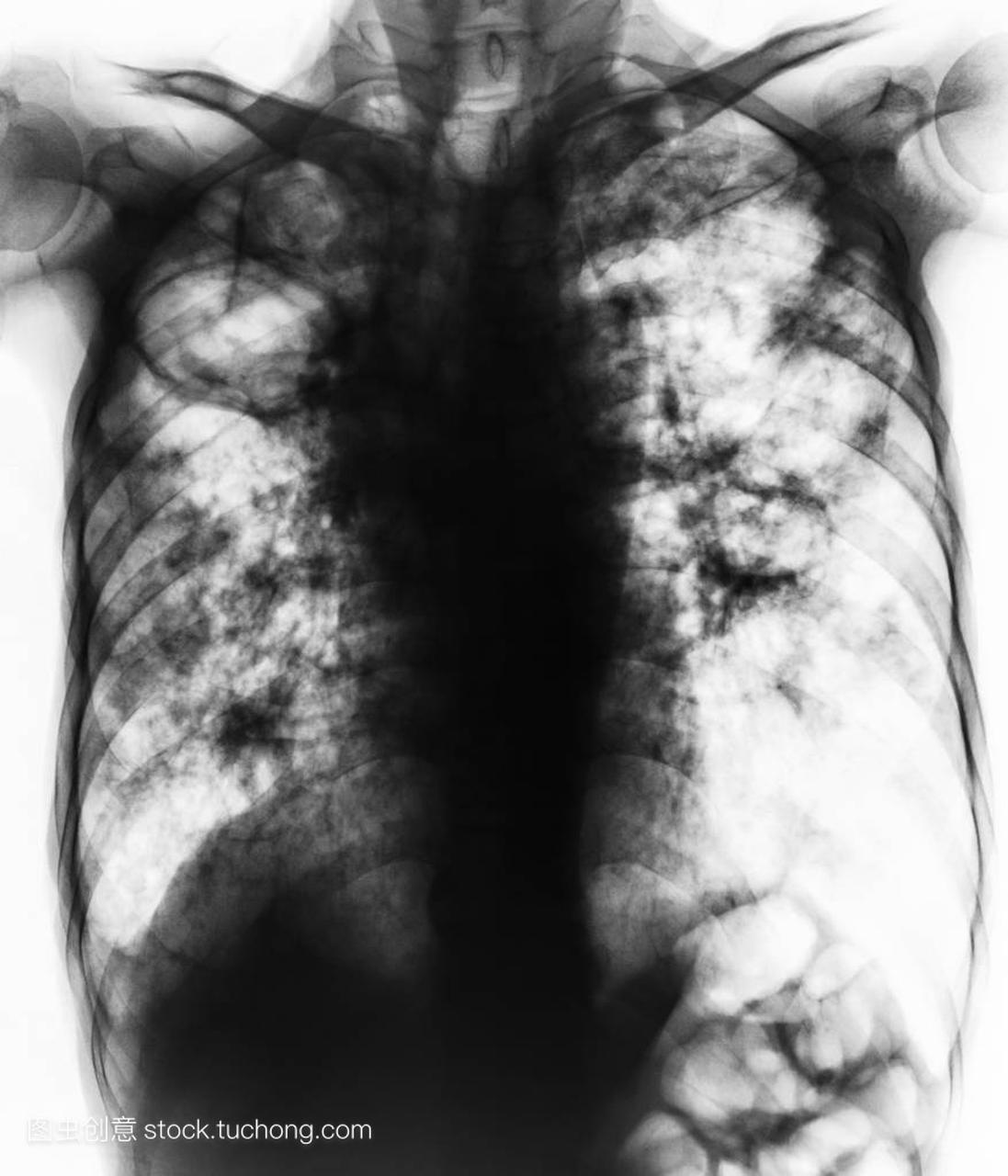 肺结核。胸部 x 光胶片显示纤维化、 腔、 间质