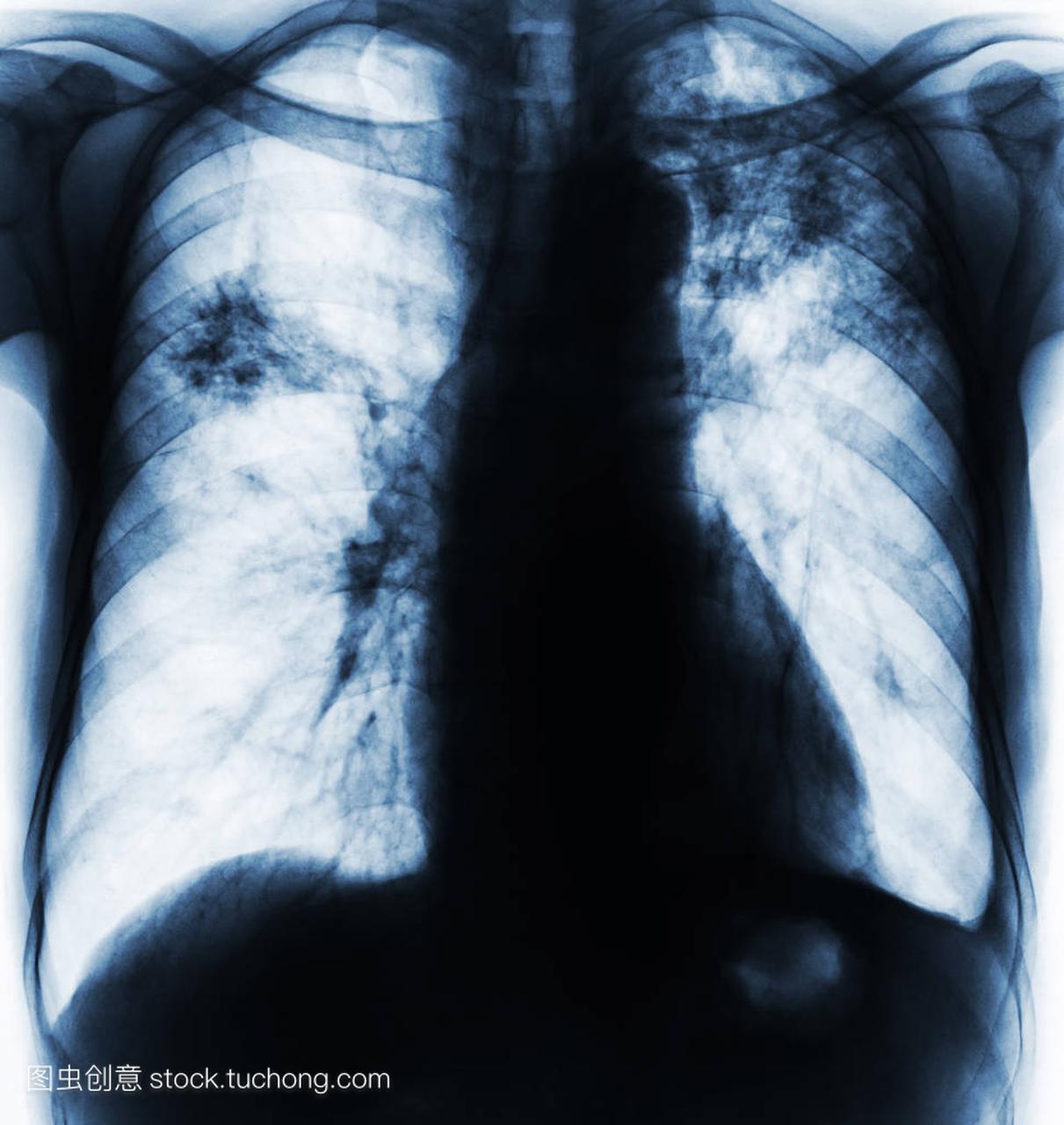 肺结核。胸部 x 光胶片显示纤维化,间质浸润由