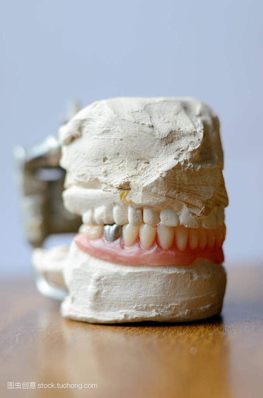 人工牙,用假银牙,牙齿上的金属冠牙体修复