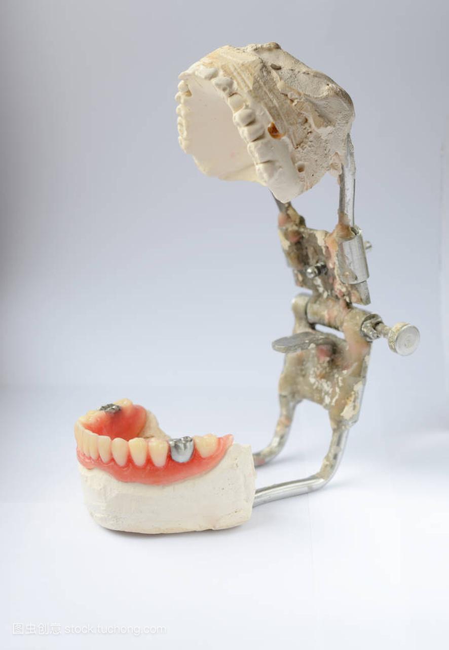 人工牙,用假银牙,牙齿上的金属冠牙体修复