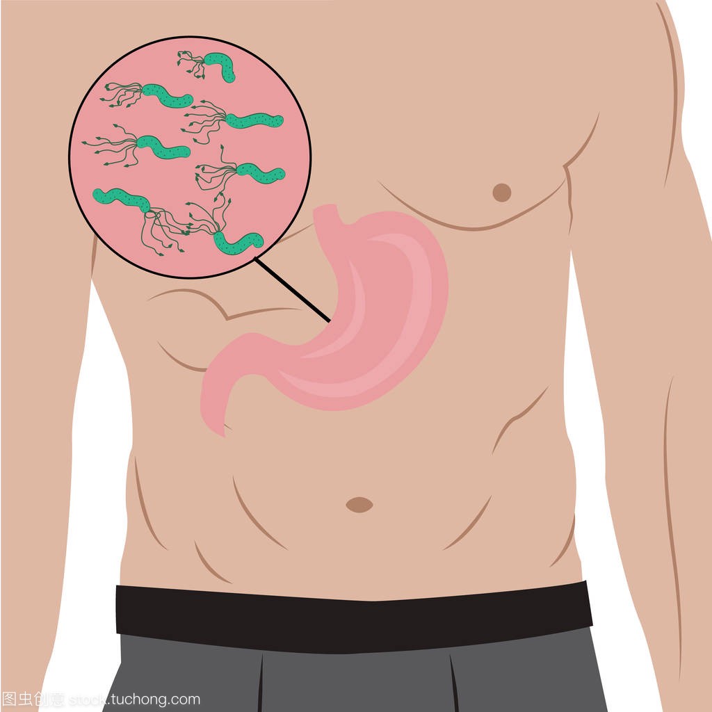 在人们的身体里充满幽门螺杆菌的胃。胃炎原因