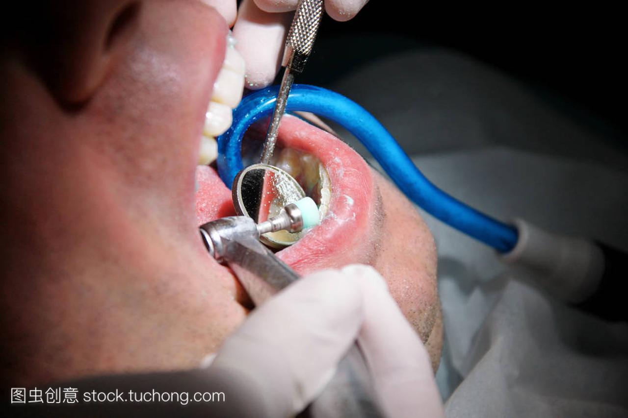 牙科牙齿抛光。牙齿清洁, 牙科卫生。牙科医生