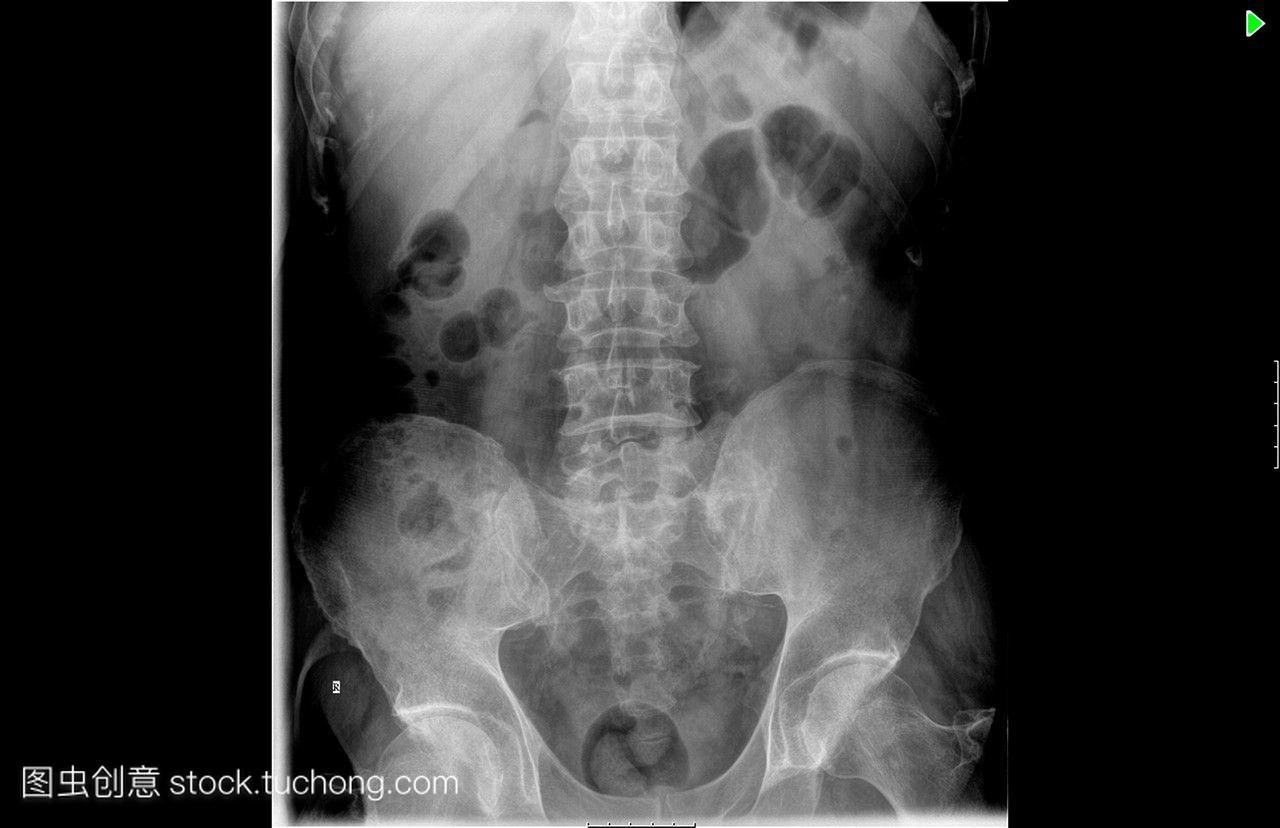 80岁男性病人盆腔x光患者腹膜炎无积液或肺结