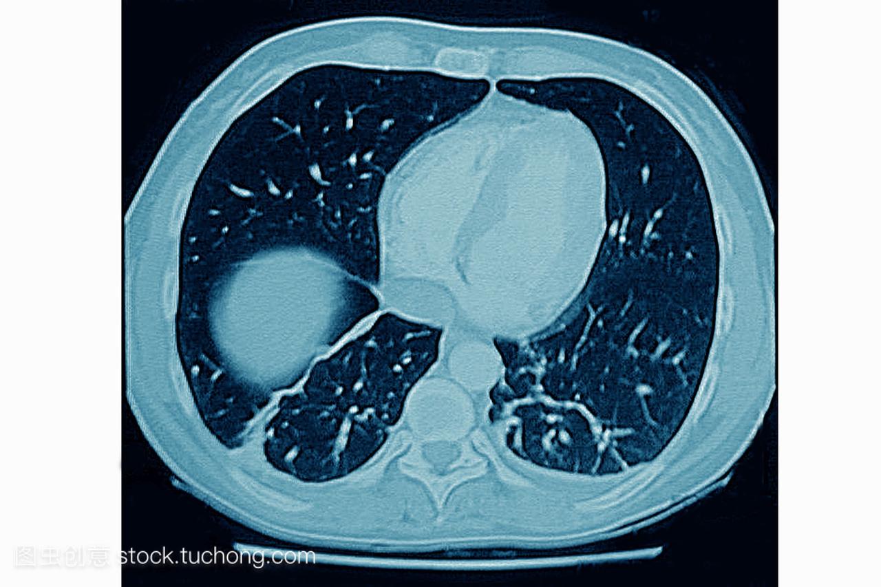 肺梗塞在胸部交叉ct扫描