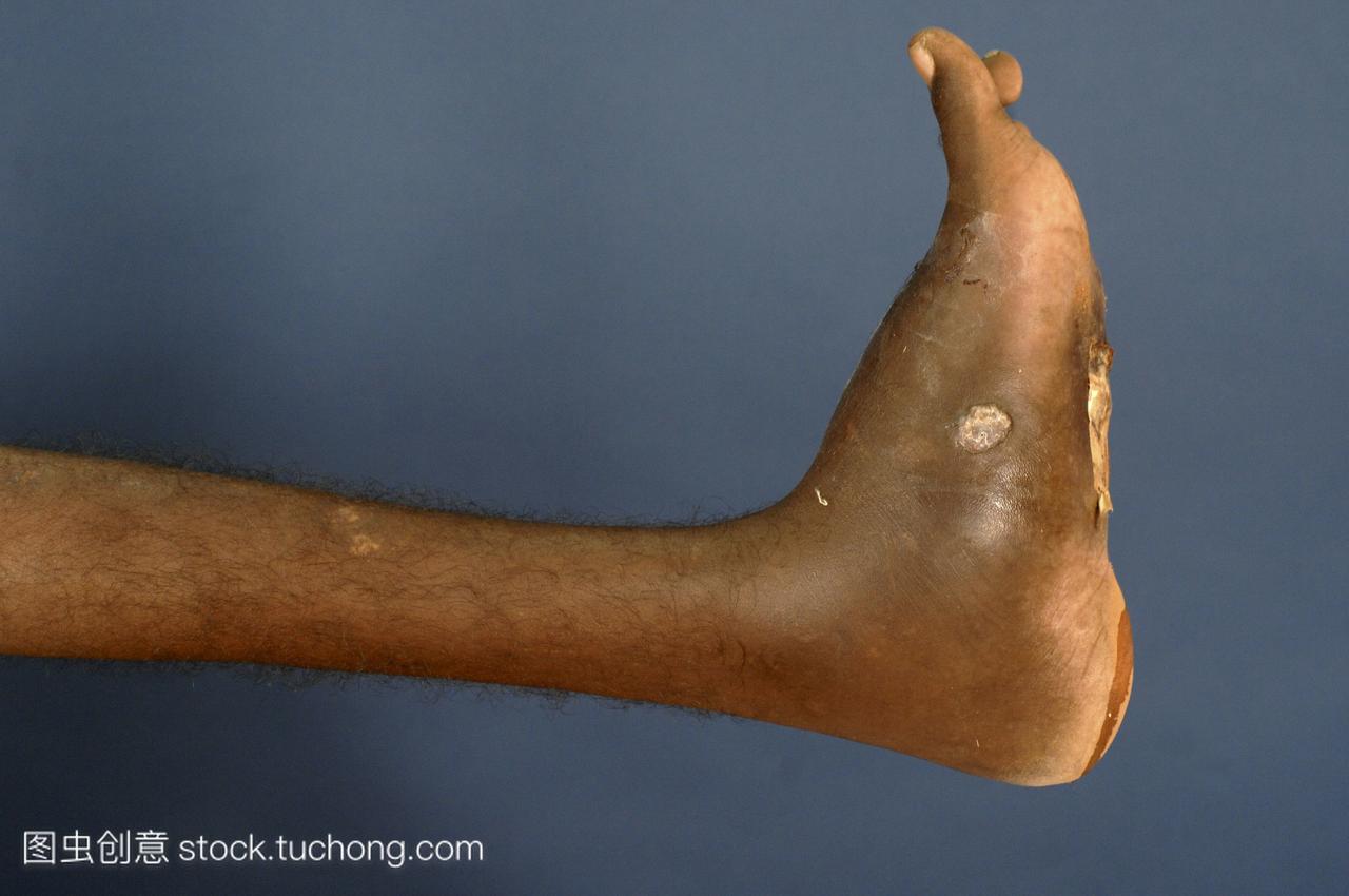 足分支菌病影响年轻男性的脚足分支菌病是一种