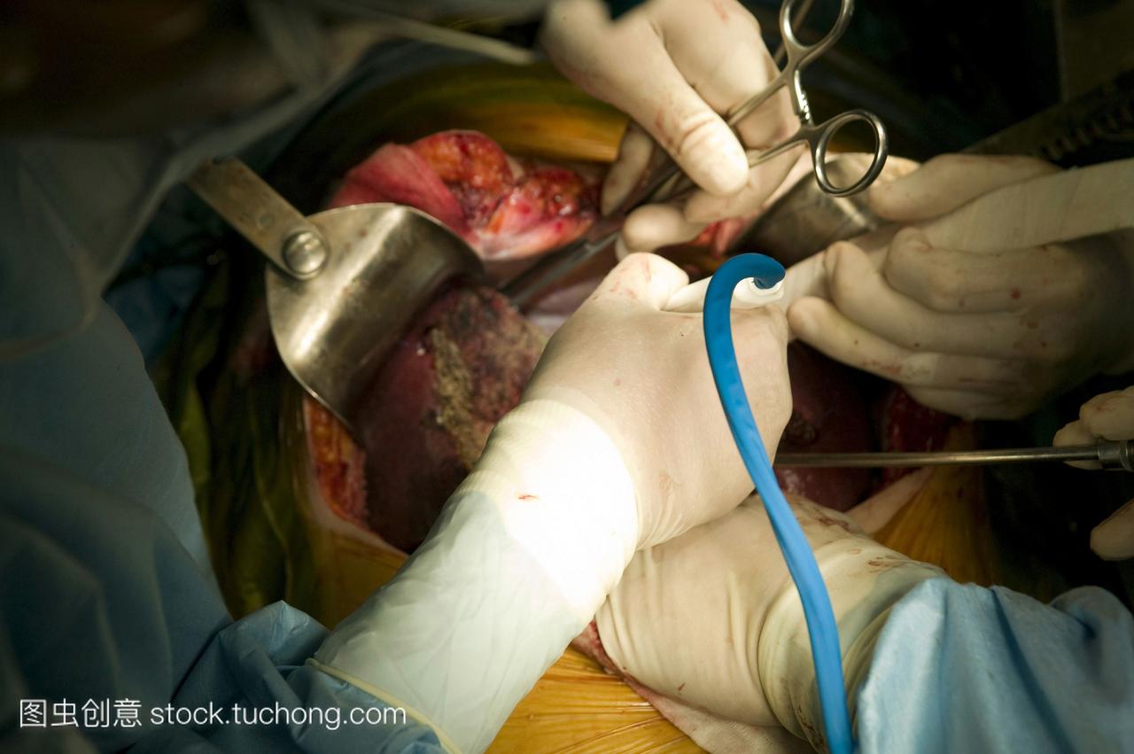 在韩国三星医疗中心进行肝脏移植手术的外科医