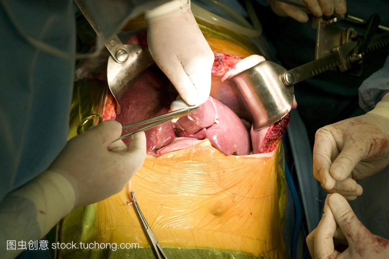 在韩国三星医疗中心进行肝脏移植手术的外科医