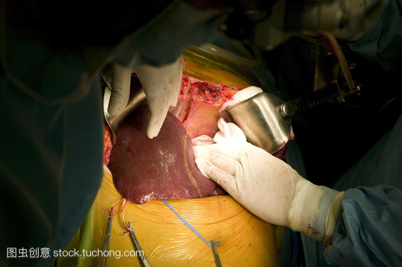 外科医生进行肝脏移植手术在韩国三星医疗中心