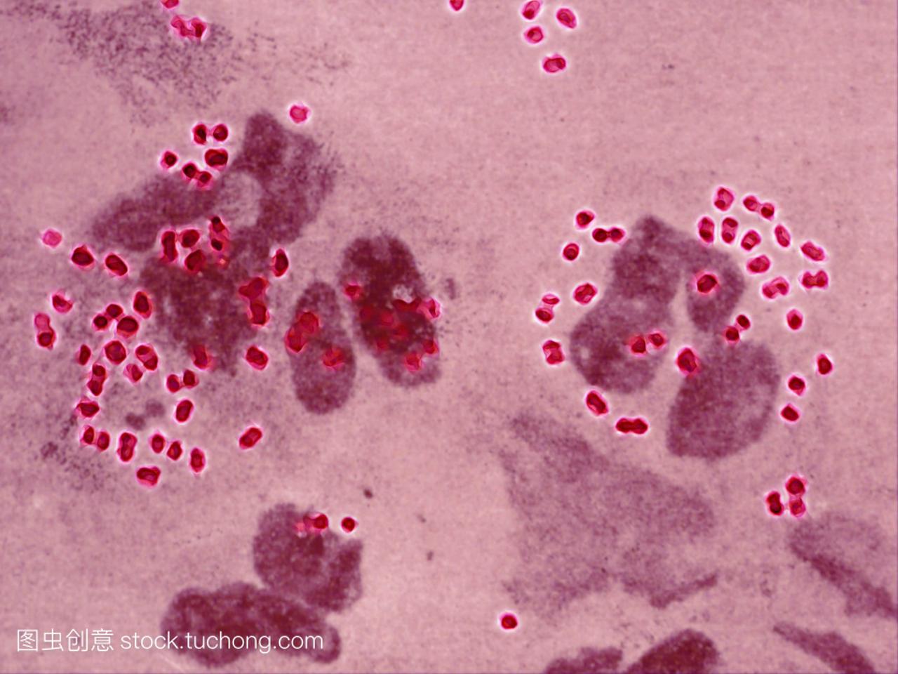淋球菌淋病奈瑟菌是对淋病的治疗。在男性中,