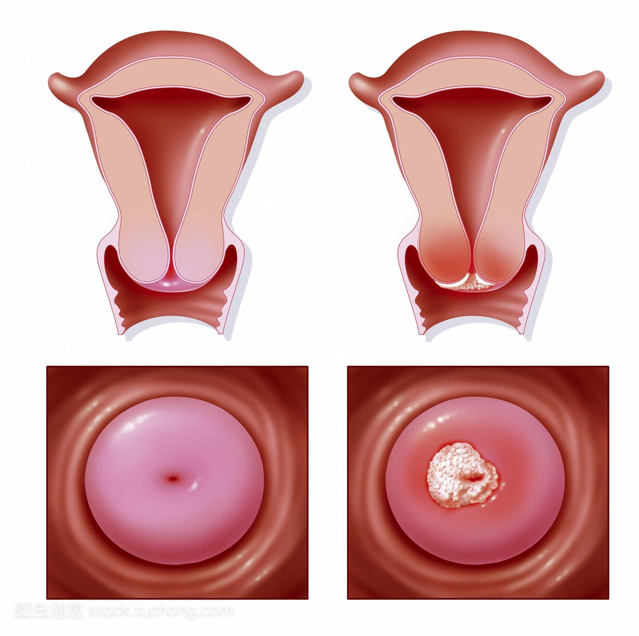 的例子宫颈癌。左边是健康子宫的前额部分顶部
