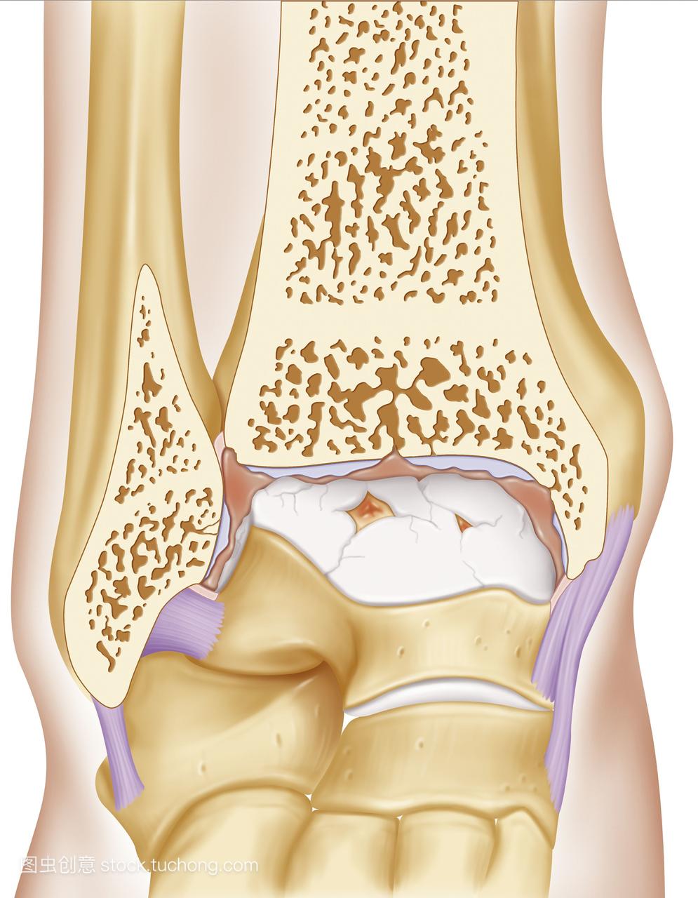 骨关节炎在踝关节骨和软骨损伤中最常见的原因