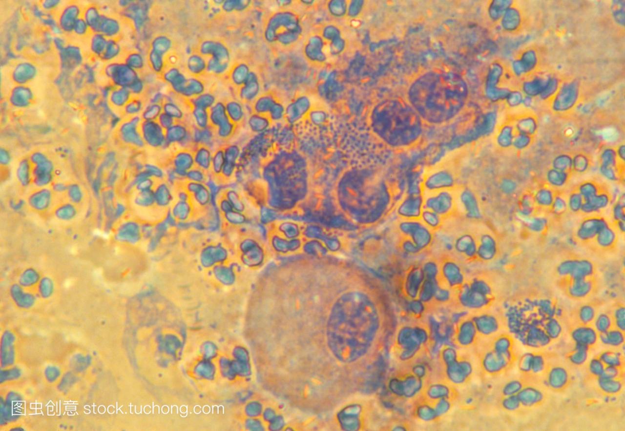 小而蓝,三种大的白血球中间,紫色感染淋球菌微