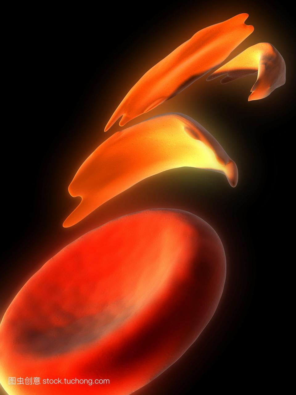 镰状细胞贫血电脑绘图显示正常红细胞低中心和