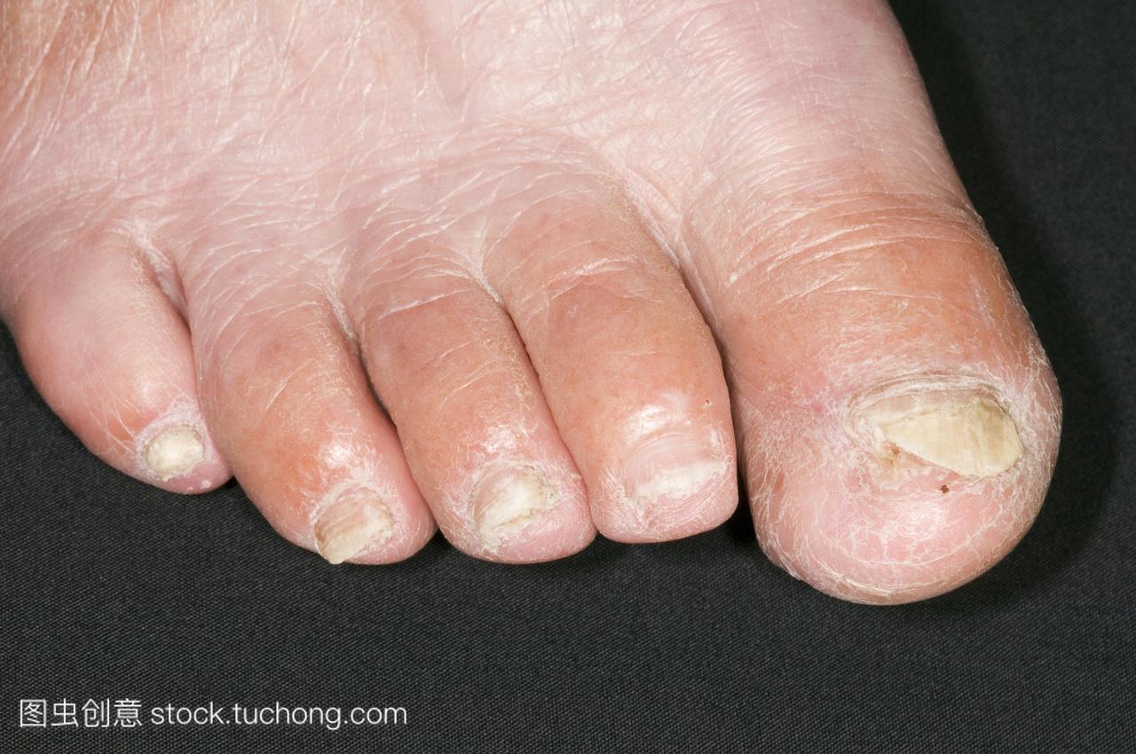 模型发布。指甲真菌感染。79岁的女人的脚趾