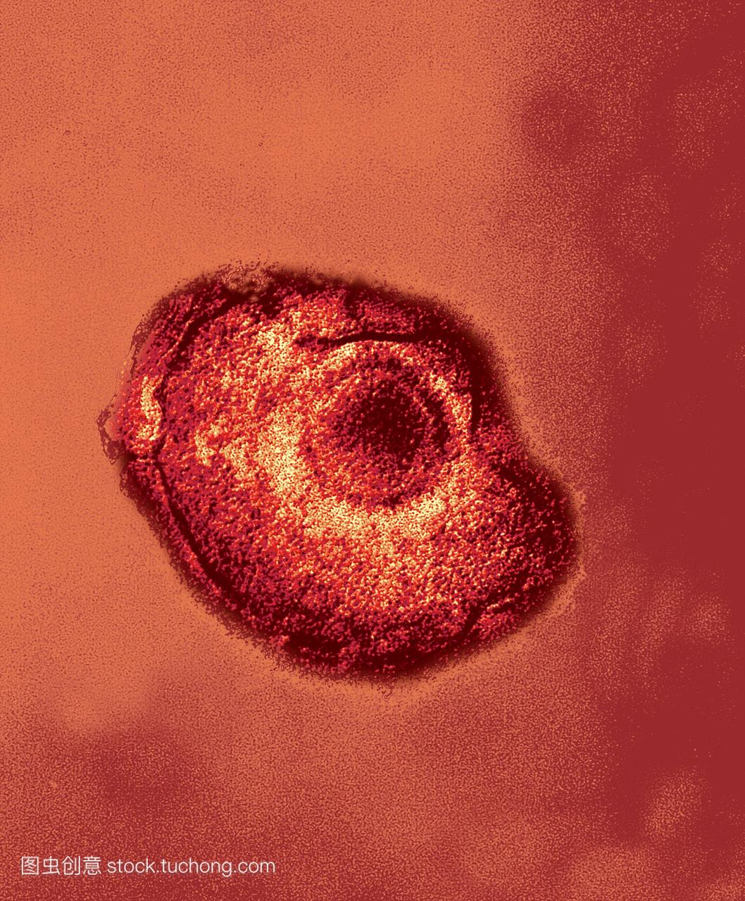 水痘带状疱疹病毒带状疱疹粒子彩色透射电子显