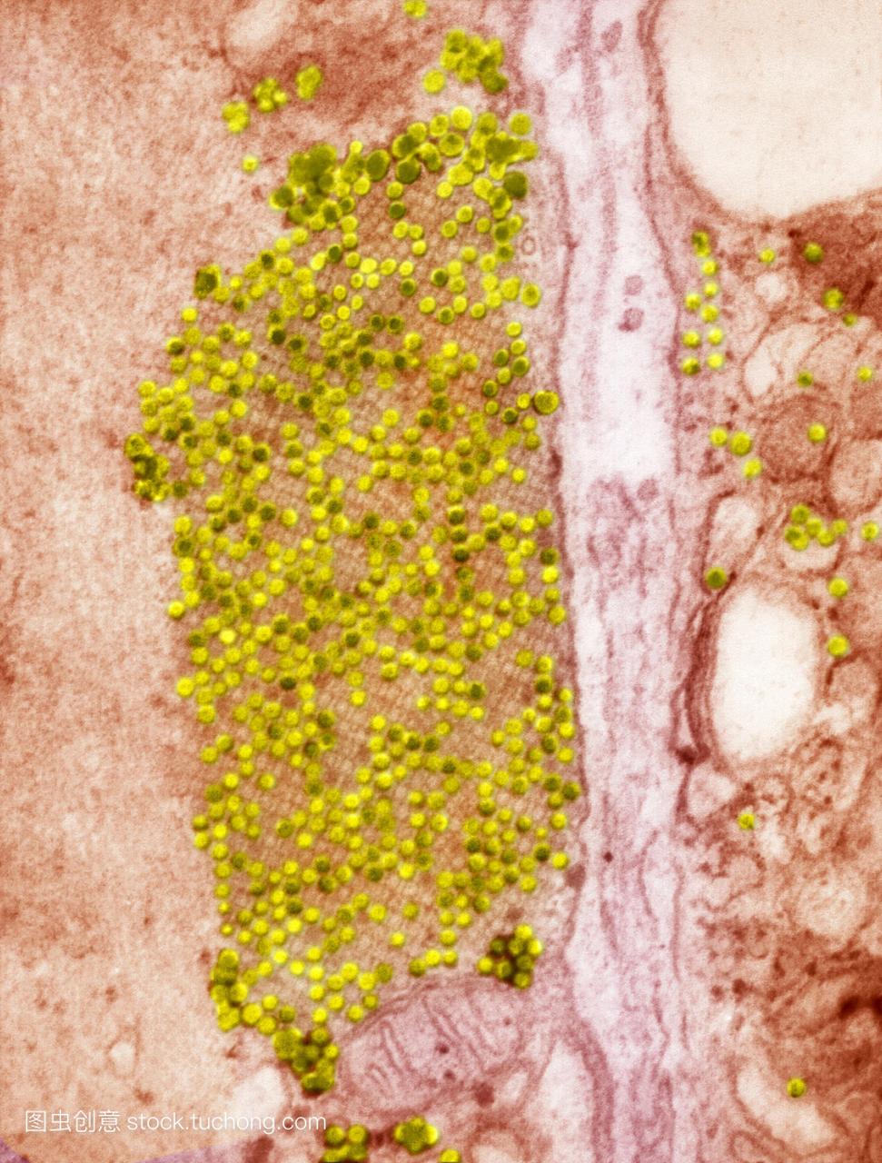 柯萨奇B3病毒颗粒,彩色透射电镜(TEM)。每个