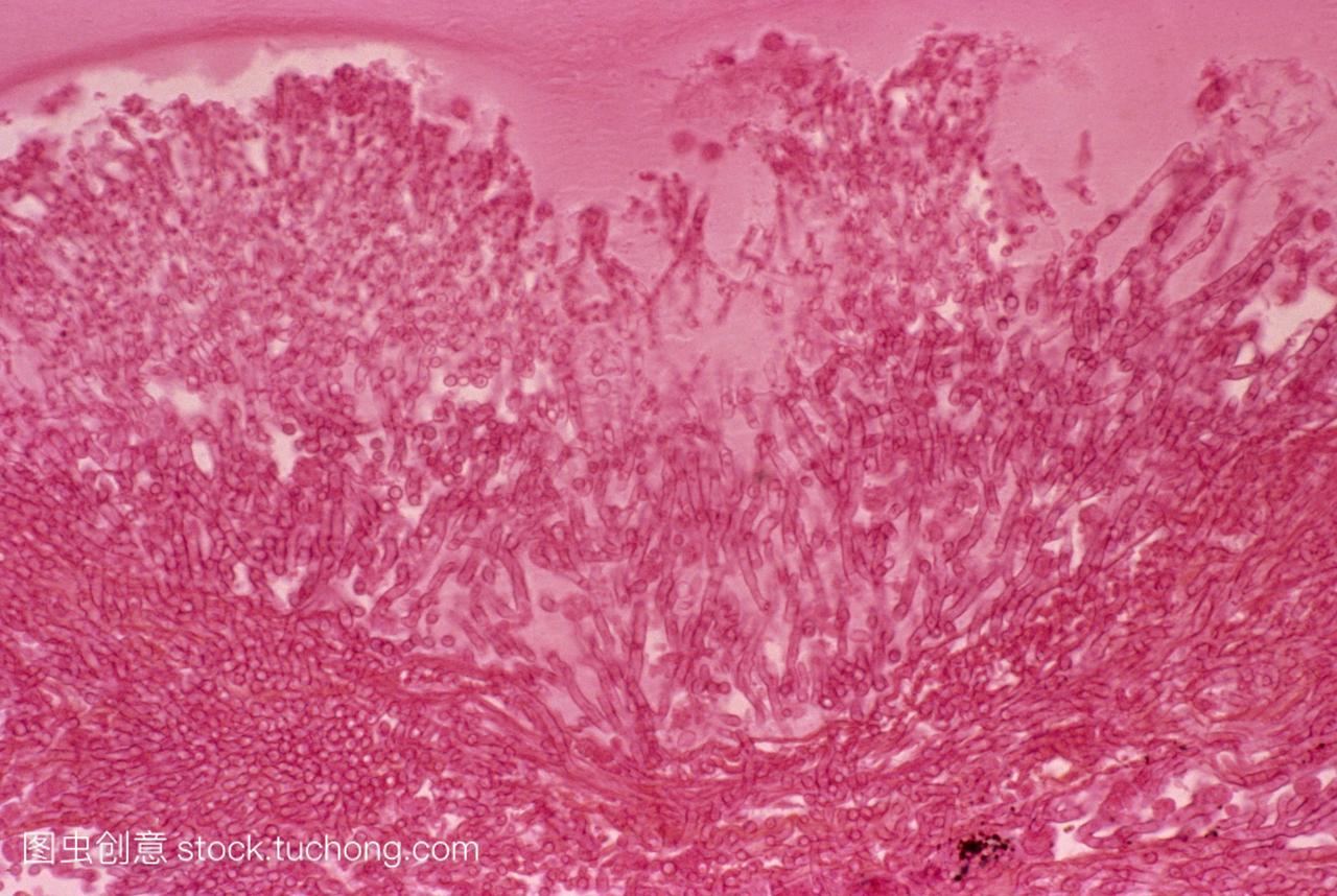 曲霉病。光显微照片一段人类肺曲霉菌感染sp