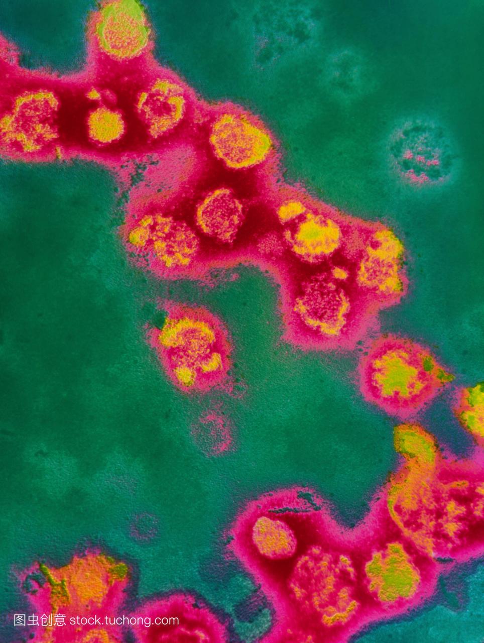 彩色透射电子显微摄影的病毒粒子风疹病毒病毒