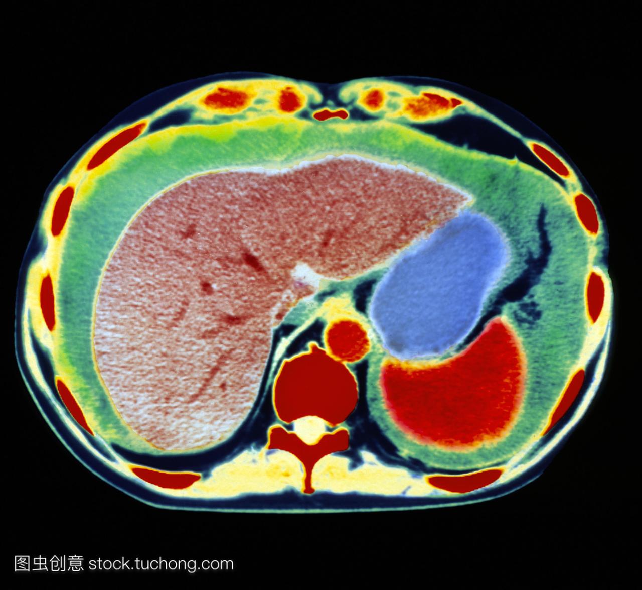 ct通过腹部的轴向切片扫描,显示腹水。左边是肝